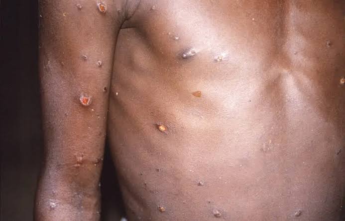 OMS: Huit pays africains ont signalé des cas confirmés de variole du singe. - Réveil d'algérie